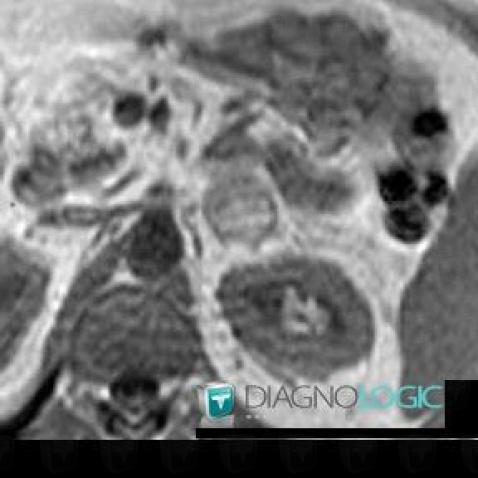 Myelolipoma, Adrenal glands, MRI