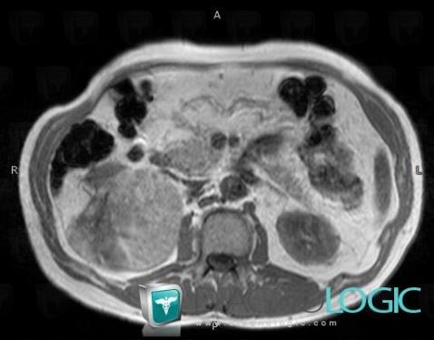 Myelolipoma, Adrenal glands, MRI