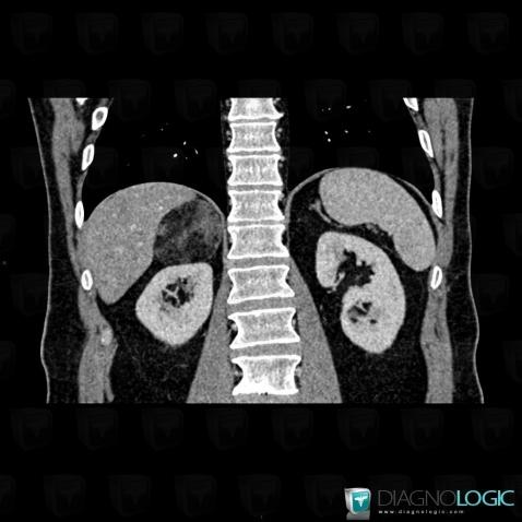 Myelolipoma, Retroperitoneum, CT