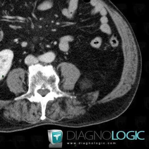 Myelolipoma, Retroperitoneum, CT