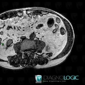 Myelolipoma, Retroperitoneum, MRI