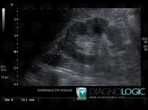 Myélolipome, Surrénales, Echographie