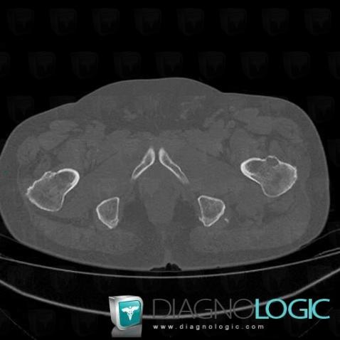 Myélome multiple , Fémur -supérieur, Scanner