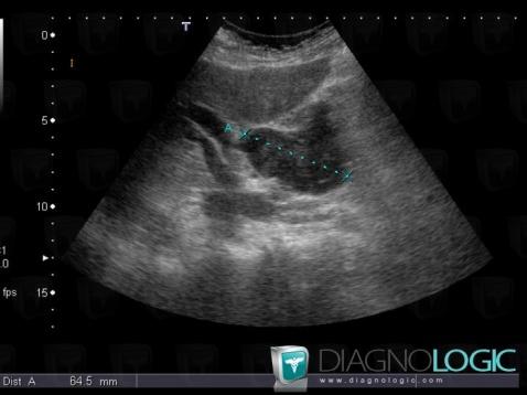 Myélome multiple , Mésentère / Péritoine, Echographie