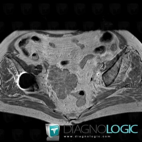 Myélome multiple , Pelvis / Périnée, IRM