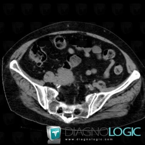 Myélome multiple , Pelvis / Périnée, Scanner