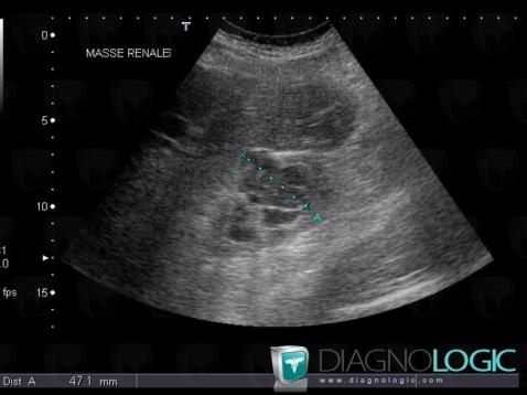 Myélome multiple , Rein, Echographie