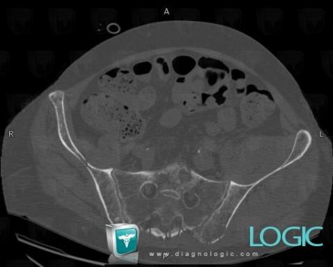 Myélome multiple , Sacrum / Coccyx, Scanner