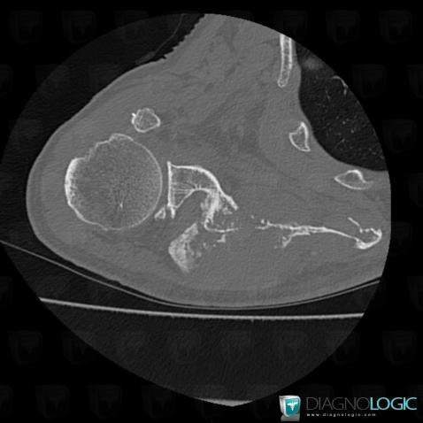 Myélome multiple , Scapula, Scanner