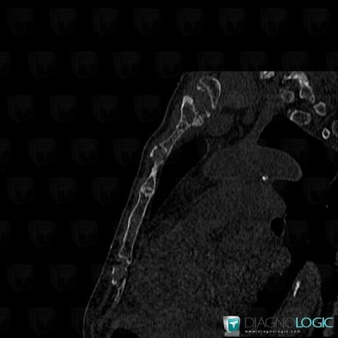 Myélome multiple , Sternum, Scanner