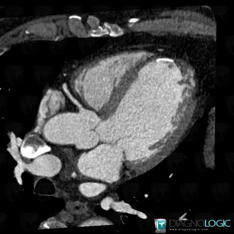 Myocardial infarction, Cardiac cavities / Pericardium, CT