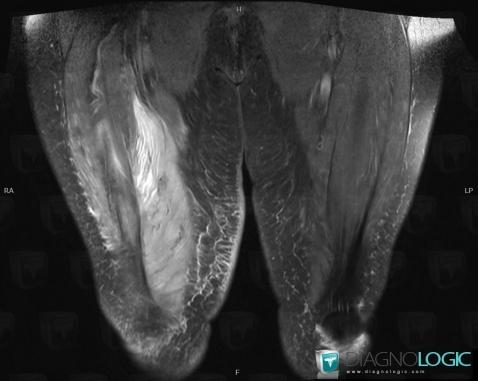 Myosite, Muscles - Cuisse, IRM