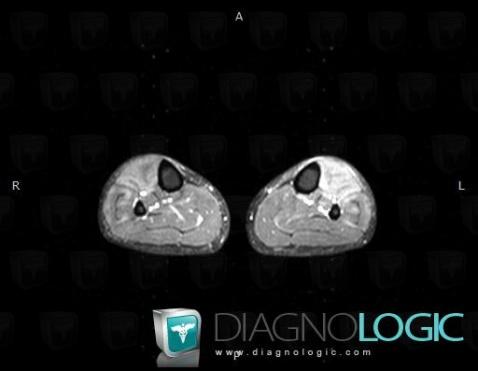 Myositis, Muscles - Leg, MRI