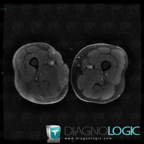 Myositis, Muscles - Thigh, MRI