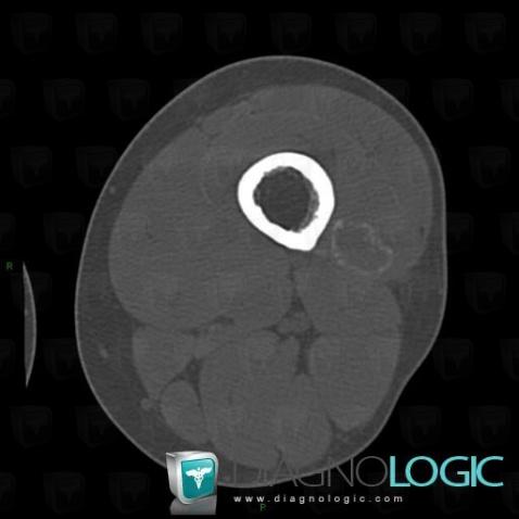 Myositis ossificans, Muscles - Thigh, CT