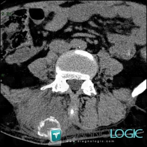 Myositis ossificans, Paraspinal, CT