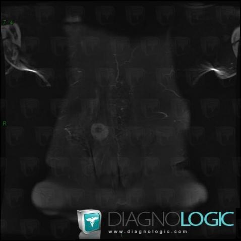 Myositis ossificans, Paraspinal, MRI