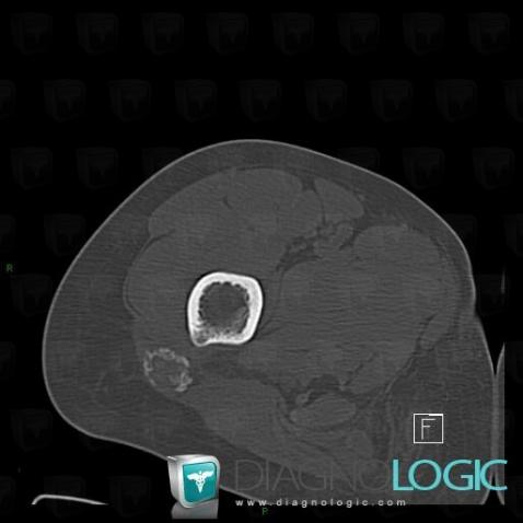 Radiology case : Myositis ossificans (CT) - Diagnologic