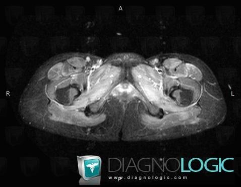 Myositis, Pelvic Muscles, MRI