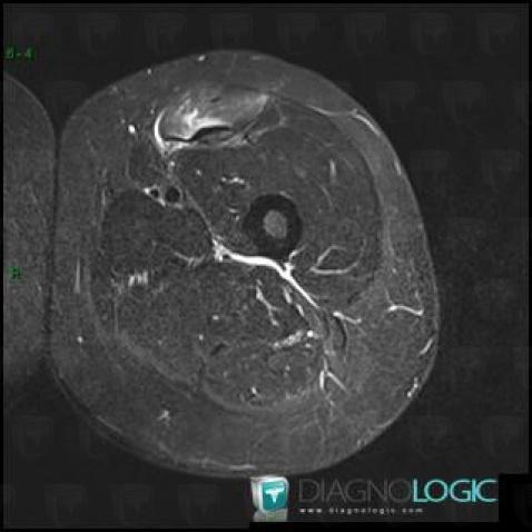 Myotendinous junction lesion, Muscles - Thigh, MRI