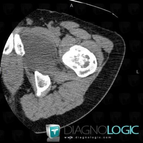 Myxoma, Pelvic Muscles, CT