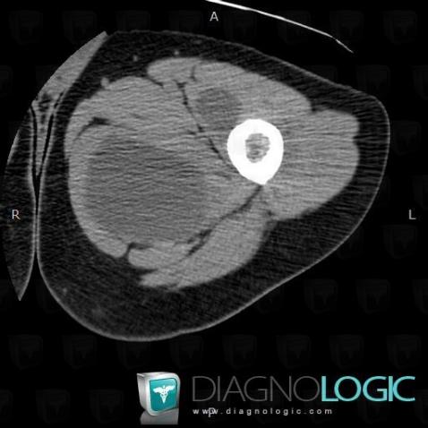 Myxome, Muscles - Cuisse, Scanner
