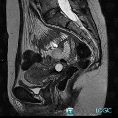 Nabothian cyst, Uterus, MRI