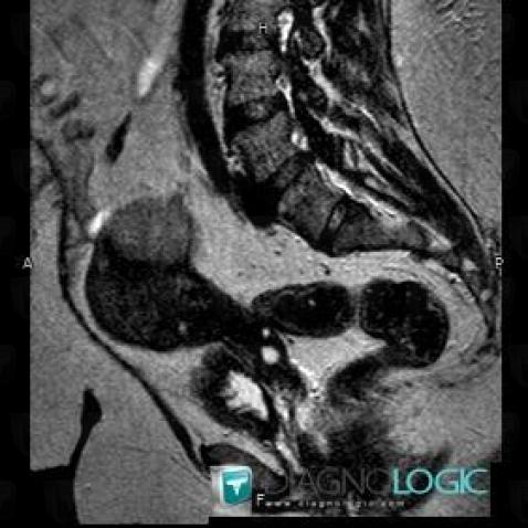 Nabothian cyst, Uterus, MRI