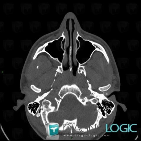 Nasopharyngeal angiofibroma, Nasal cavity / Nasopharynx, CT