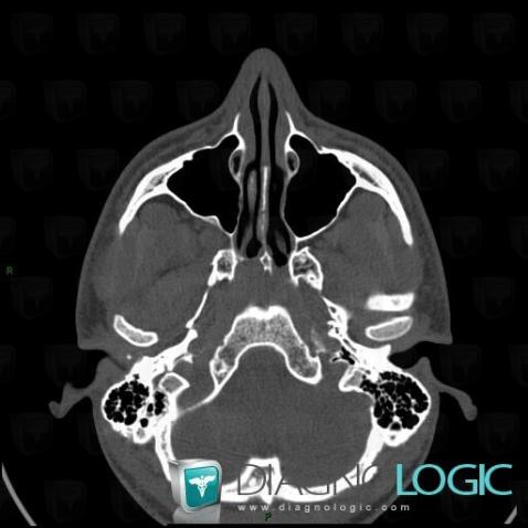 Nasopharyngeal angiofibroma, Nasal cavity / Nasopharynx, CT