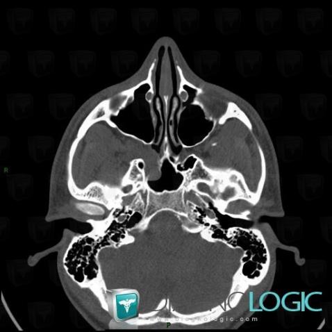 Nasopharyngeal angiofibroma, Sinus, Deep facial spaces, CT