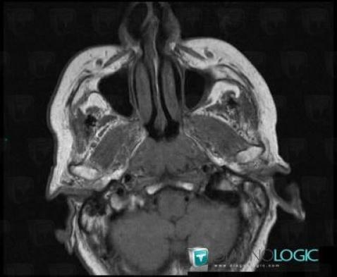 Nasopharynx cancer, Nasal cavity / Nasopharynx, MRI