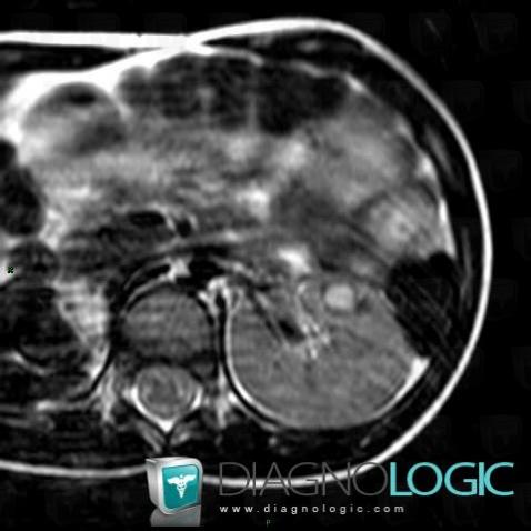 Néphroblastomatose, Rein, IRM