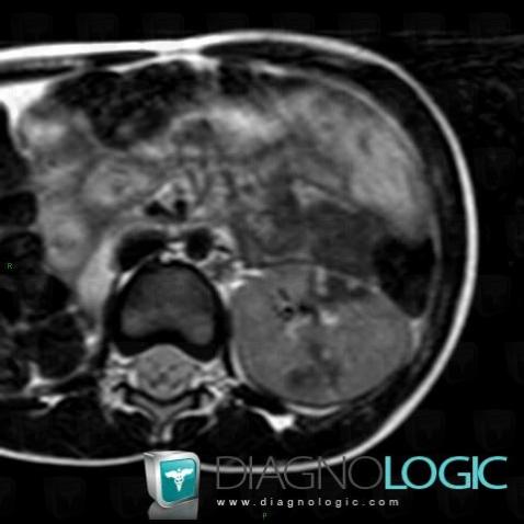 Néphroblastomatose, Rein, IRM