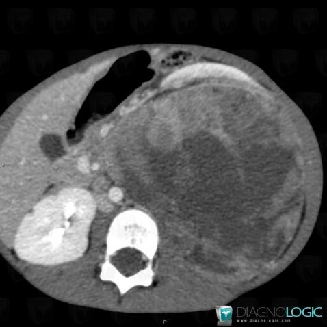 Néphroblastome, Rein, Rétroperitoine, Scanner