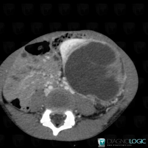 Néphroblastome, Rétroperitoine, Scanner