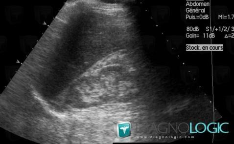 Néphrocalcinose, Rein, Echographie