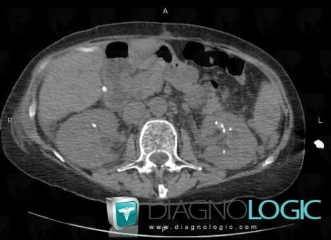 Nephrocalcinosis, Kidney, CT