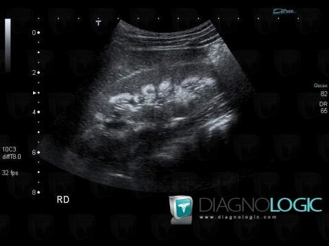 Nephrocalcinosis, Kidney, US