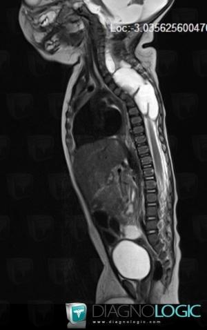 Neurenteric cyst, Spinal canal / Cord, MRI