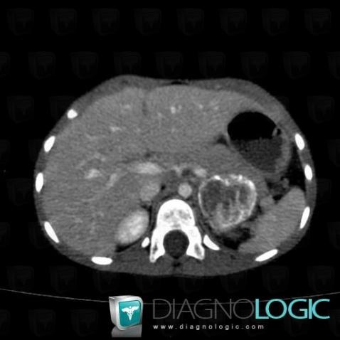 Neuroblastoma, Adrenal glands, CT