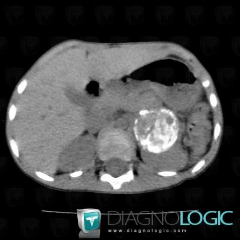 Neuroblastoma, Adrenal glands, CT