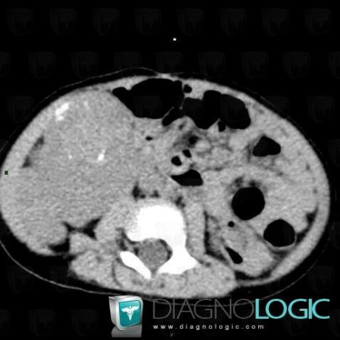 Neuroblastoma, Adrenal glands, CT