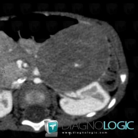 Neuroblastoma, Adrenal glands, CT