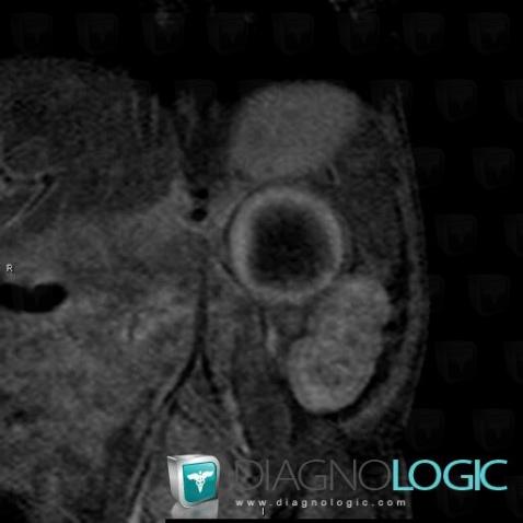 Neuroblastoma, Adrenal glands, MRI