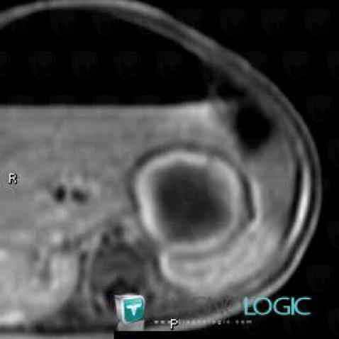 Neuroblastoma, Adrenal glands, MRI