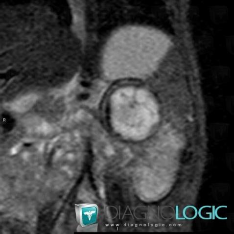 Neuroblastoma, Adrenal glands, MRI