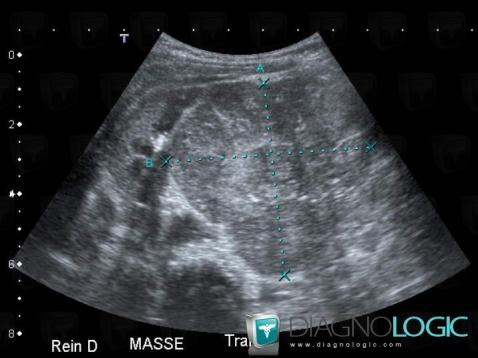 Neuroblastoma, Adrenal glands, US