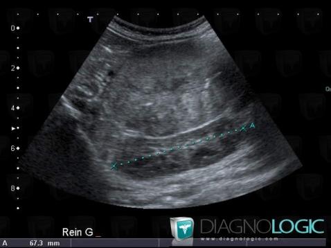 Neuroblastoma, Adrenal glands, US