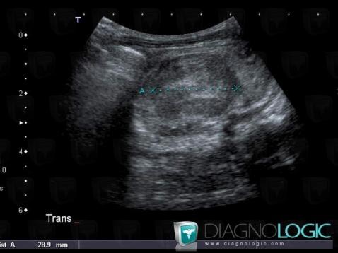 Neuroblastoma, Adrenal glands, US